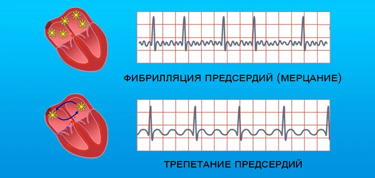 Трепетание предсердий на ЭКГ